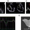 Clinical Significance of Right Ventricular Function in Pulmonary Hypertension [Published online in advanced , by J-STAGE]