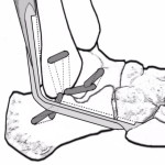 Anatomical Tenodesis Reconstruction Using Free Split Peroneal Brevis Tendon for Severe Chronic Lateral Ankle Instability [Published online Keio J Med, 71, 44-49, by J-STAGE]