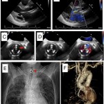 Reoperative Aortic Valve Replacement for Structural Valve Deterioration through a Lower Hemisternotomy after a Previous Bentall Procedure in a Patient with Tracheostomy [Published online Keio J Med, 72, 21-25, by J-STAGE]
