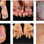 Pachyonychia Congenita: Clinical Features and Future Treatments [Published online in advanced , by J-STAGE]